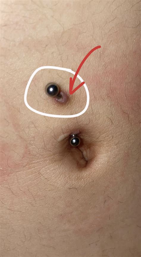 belly button piercing with keloid